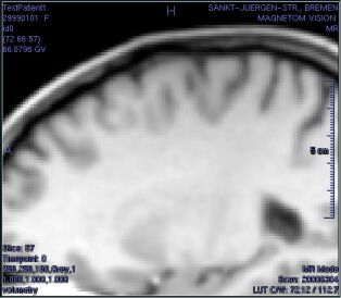 ../../../Modules/ML/MLFilter1/mhelp/Images/DiffusionExampleIso.jpg