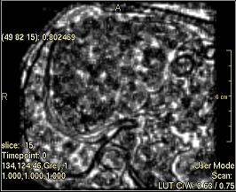 ../../../Modules/ML/MLFilter2/mhelp/Images/TextureFilterImages/SecondMoment(Ngldm).jpg
